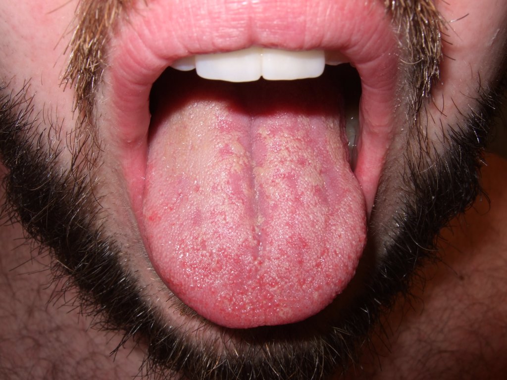 Red Dry Patch On Tongue